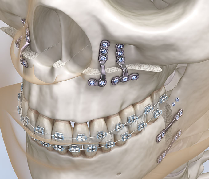 Kombiniert kieferorthopädischer / kieferchirurgischer Ansatz (Dysgnathiechirurgie)