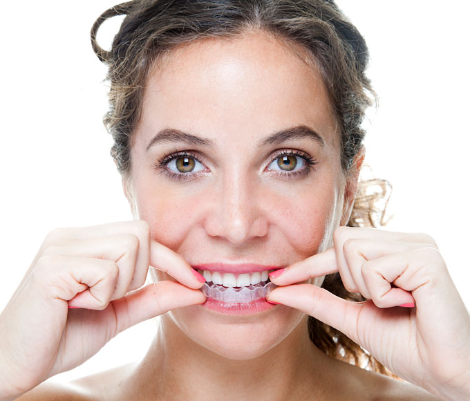 Unsichtbare Zahnspange, Aligner-Behandlung